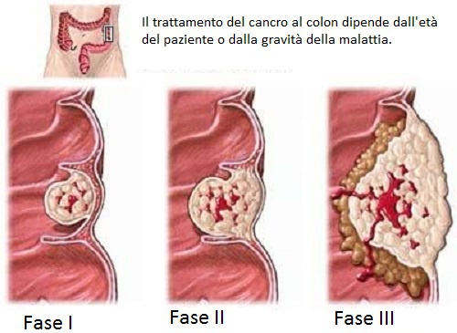 Le varie fasi del cancro al colon.