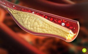 Il colesterolo può occludere i vasi sanguigni